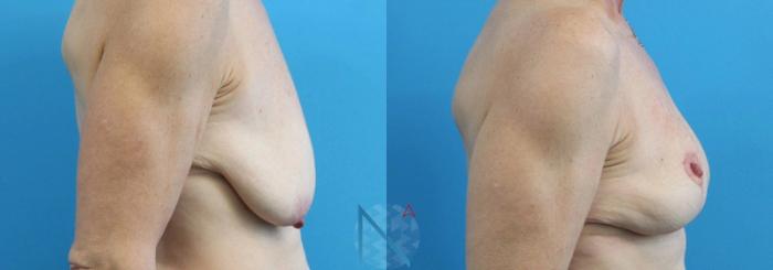 Before & After Breast Lift Case 48 View 3 View in Raleigh, NC