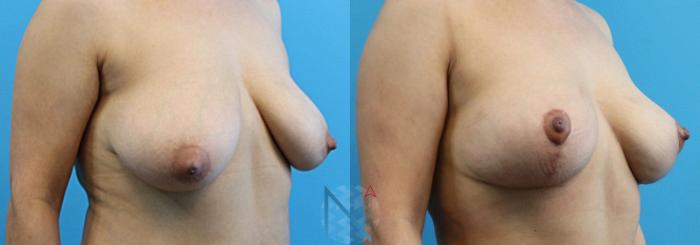 Before & After Breast Lift Case 49 View 2 View in Raleigh, NC