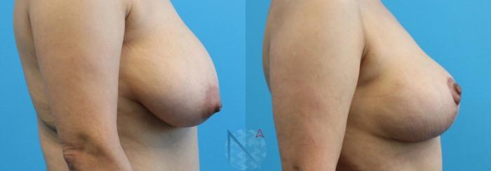 Before & After Breast Lift Case 49 View 3 View in Raleigh, NC