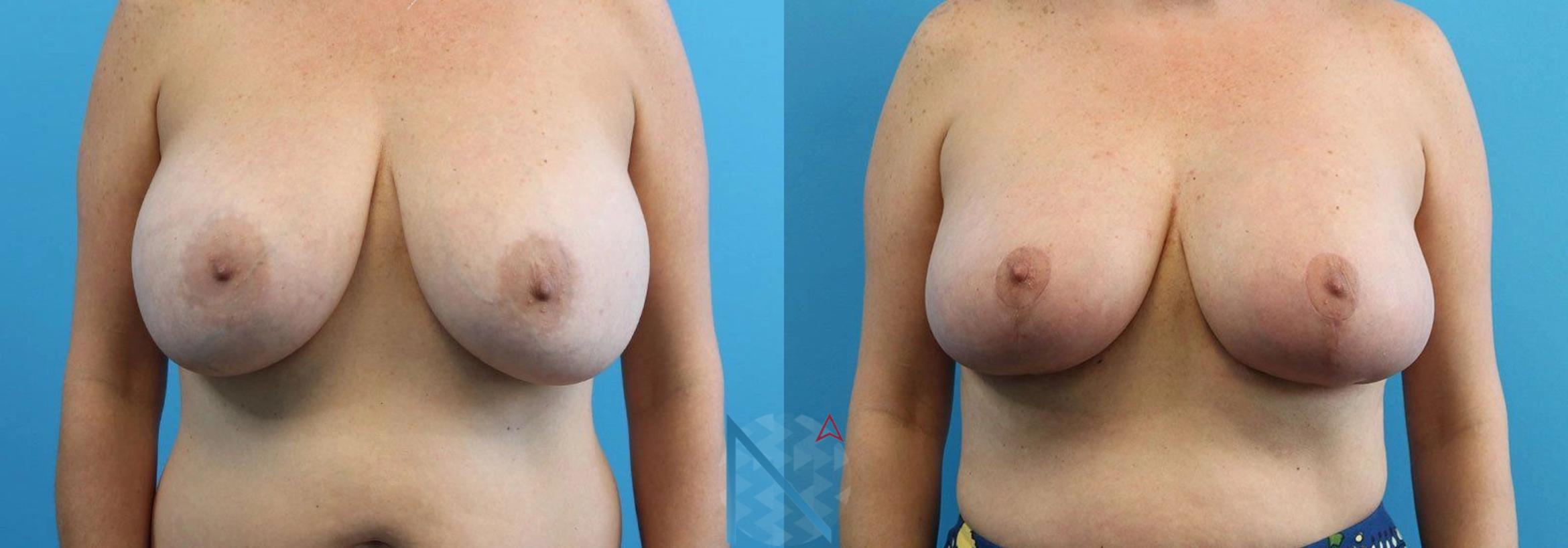 Before & After Breast Lift Case 50 View 1 View in Raleigh, NC