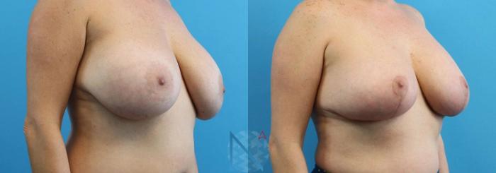 Before & After Breast Lift Case 50 View 2 View in Raleigh, NC