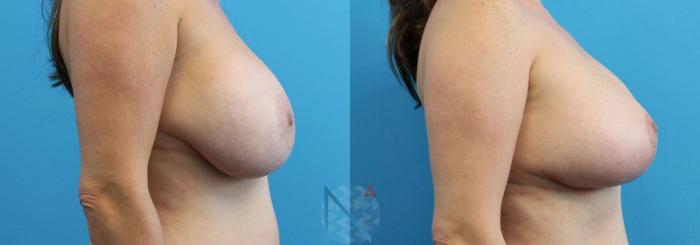 Before & After Breast Lift Case 50 View 3 View in Raleigh, NC