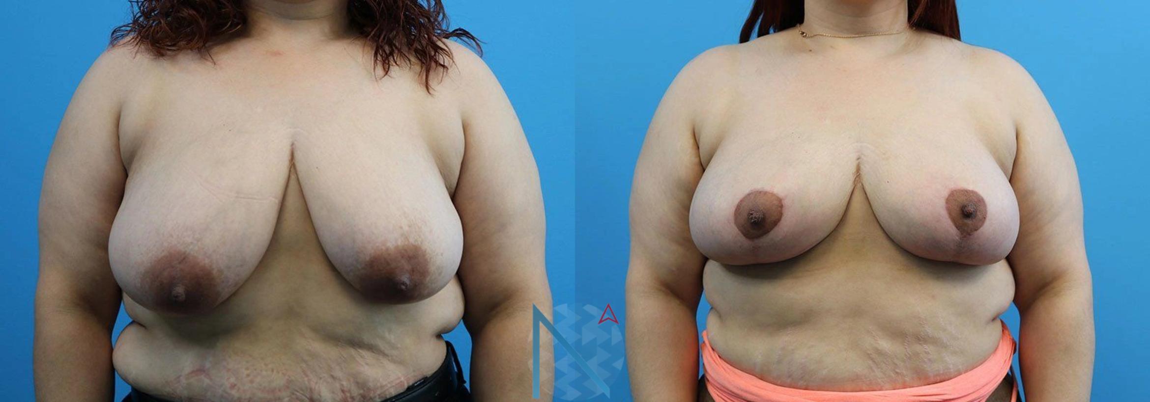 Before & After Breast Lift Case 51 View 1 View in Raleigh, NC