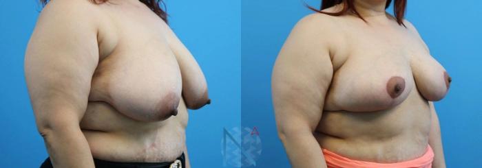 Before & After Breast Lift Case 51 View 2 View in Raleigh, NC