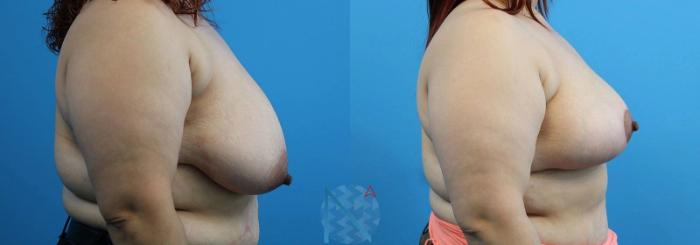 Before & After Breast Lift Case 51 View 3 View in Raleigh, NC