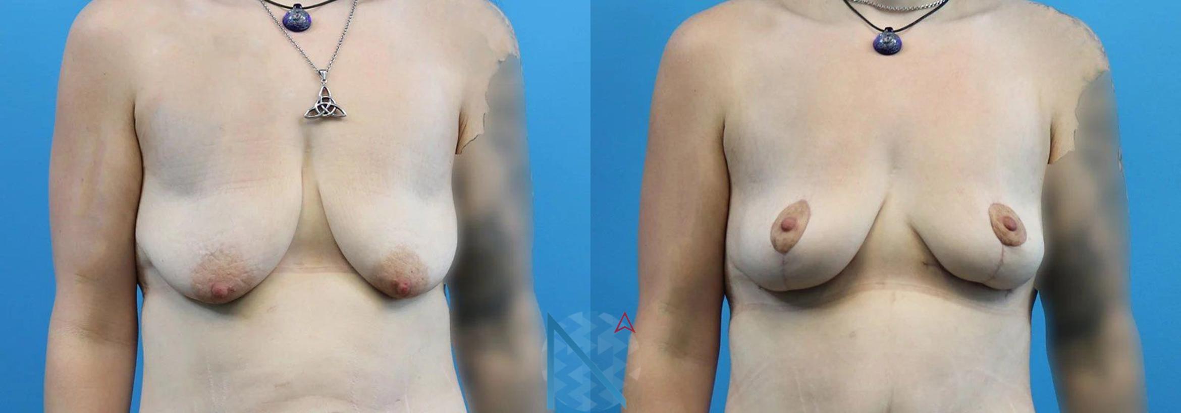 Before & After Breast Lift Case 52 View 1 View in Raleigh, NC