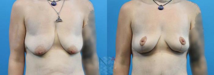 Before & After Breast Lift Case 52 View 1 View in Raleigh, NC