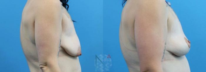 Before & After Breast Lift Case 52 View 3 View in Raleigh, NC