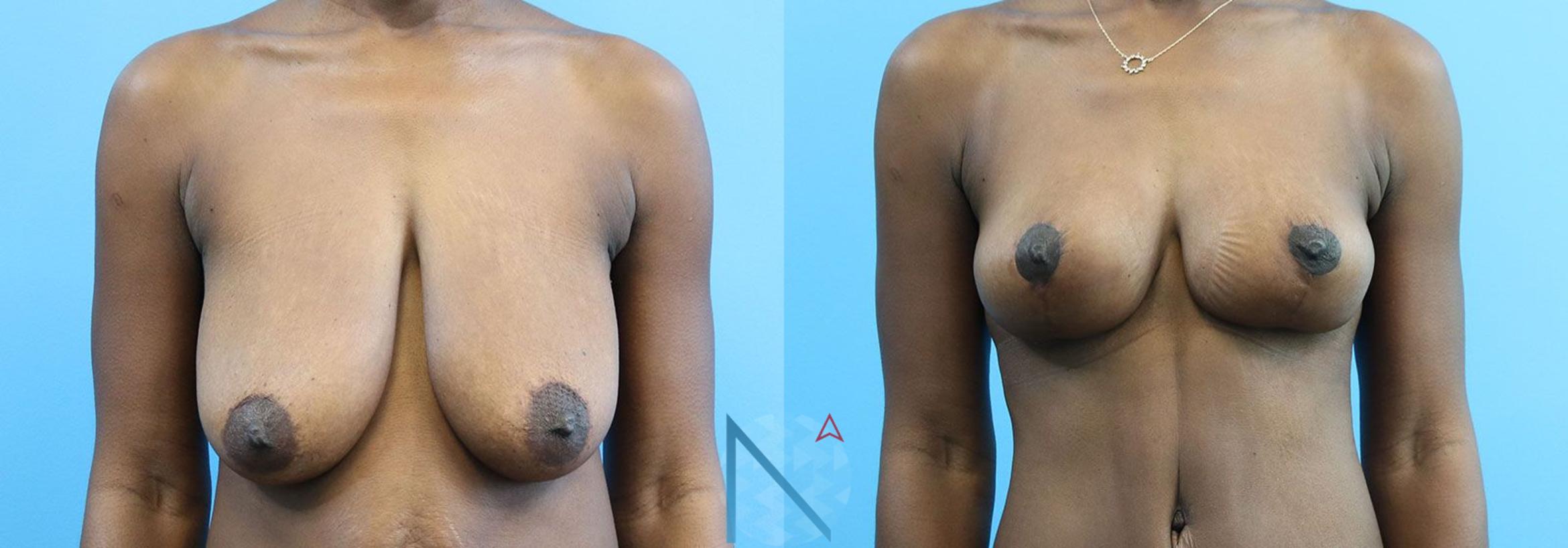 Before & After Breast Lift Case 53 View 1 View in Raleigh, NC