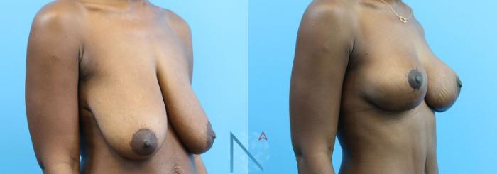 Before & After Breast Lift Case 53 View 2 View in Raleigh, NC