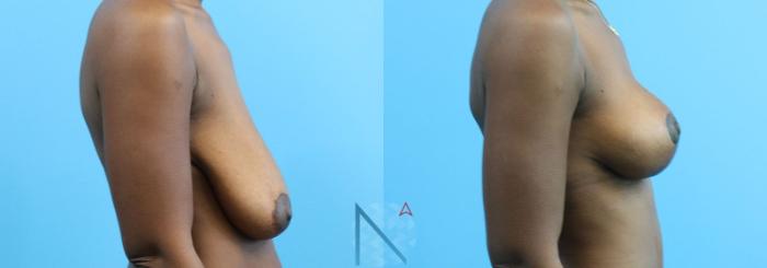 Before & After Breast Lift Case 53 View 3 View in Raleigh, NC