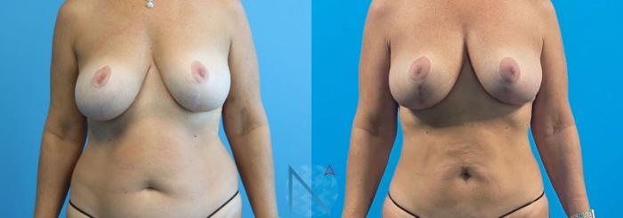 Before & After Breast Lift Case 54 View 1 View in Raleigh, NC