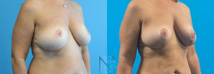 Before & After Breast Lift Case 54 View 2 View in Raleigh, NC