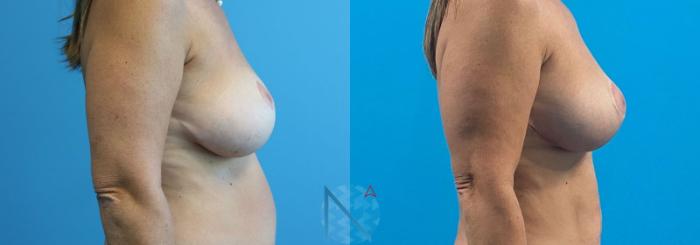 Before & After Breast Lift Case 54 View 3 View in Raleigh, NC