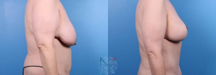 Before & After Breast Lift Case 55 View 3 View in Raleigh, NC