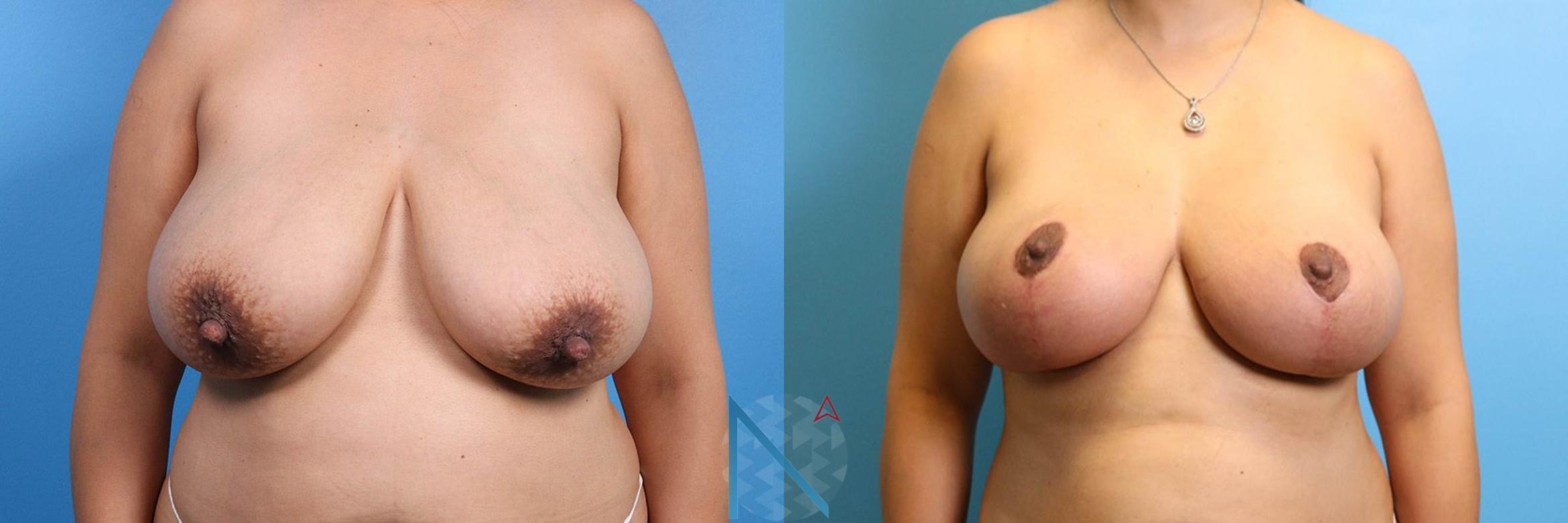 Before & After Breast Lift Case 56 View 1 View in Raleigh, NC