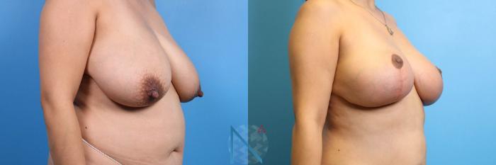 Before & After Breast Lift Case 56 View 2 View in Raleigh, NC