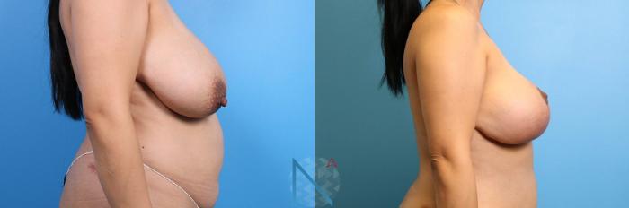 Before & After Breast Lift Case 56 View 3 View in Raleigh, NC