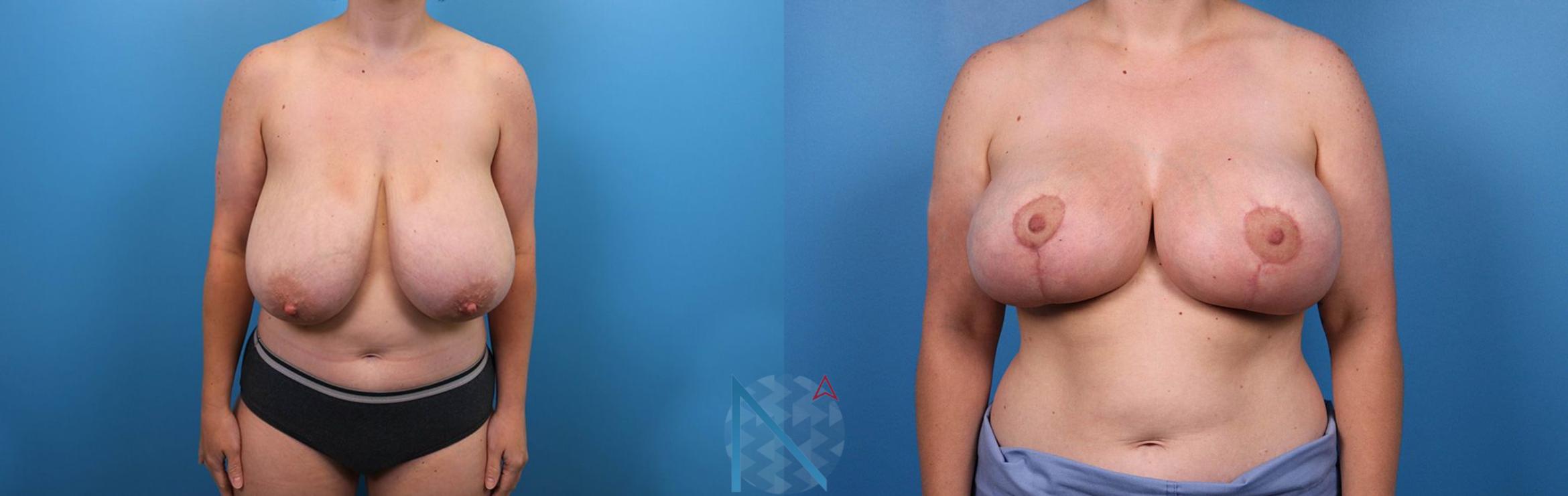 Before & After Breast Lift Case 57 View 1 View in Raleigh, NC