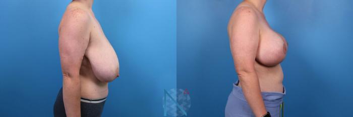 Before & After Breast Lift Case 57 View 3 View in Raleigh, NC