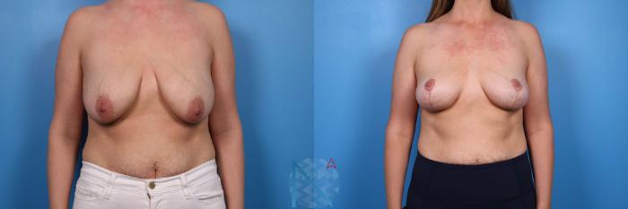 Before & After Breast Lift Case 59 View 1 View in Raleigh, NC