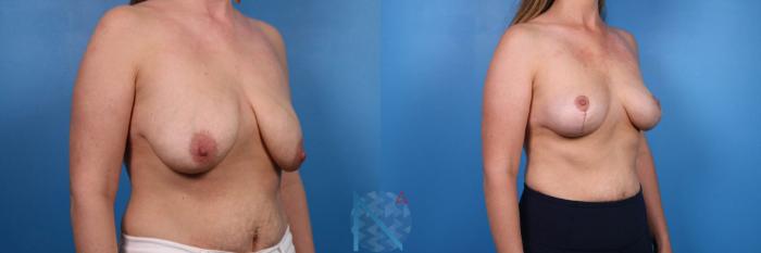 Before & After Breast Lift Case 59 View 2 View in Raleigh, NC