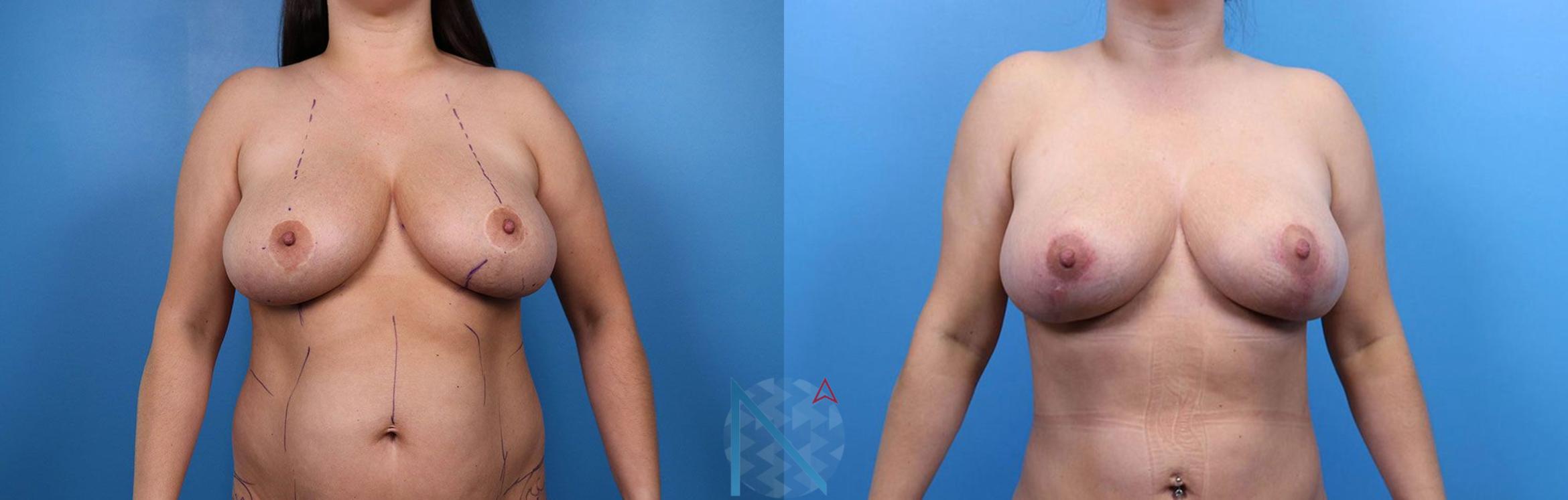 Before & After Breast Lift Case 60 View 1 View in Raleigh, NC