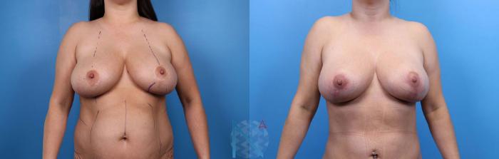 Before & After Breast Lift Case 60 View 1 View in Raleigh, NC