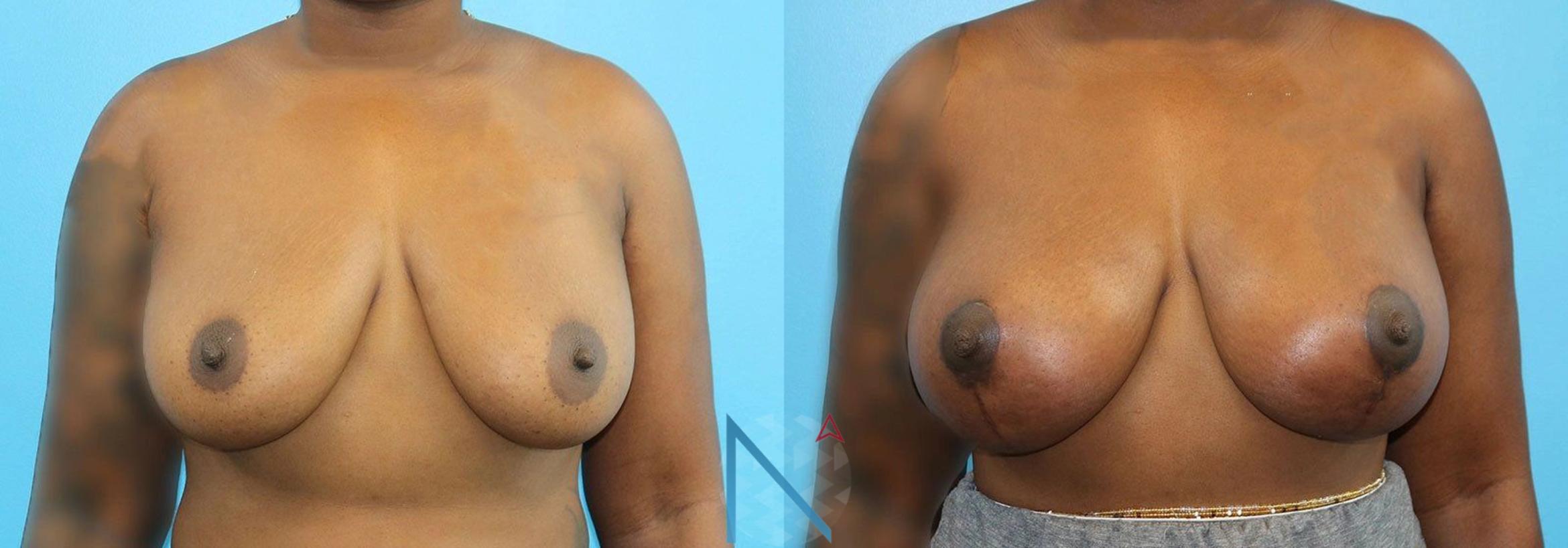 Before & After Breast Lift with Augmentation Case 61 View 1 View in Raleigh, NC