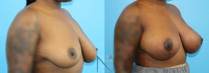 Before & After Breast Lift with Augmentation Case 61 View 2 View in Raleigh, NC