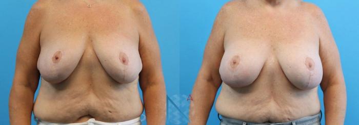 Before & After Breast Lift with Augmentation Case 62 View 1 View in Raleigh, NC