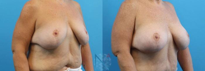 Before & After Breast Lift with Augmentation Case 62 View 2 View in Raleigh, NC