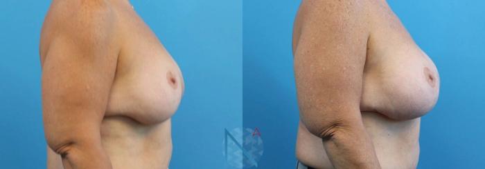 Before & After Breast Lift with Augmentation Case 62 View 3 View in Raleigh, NC