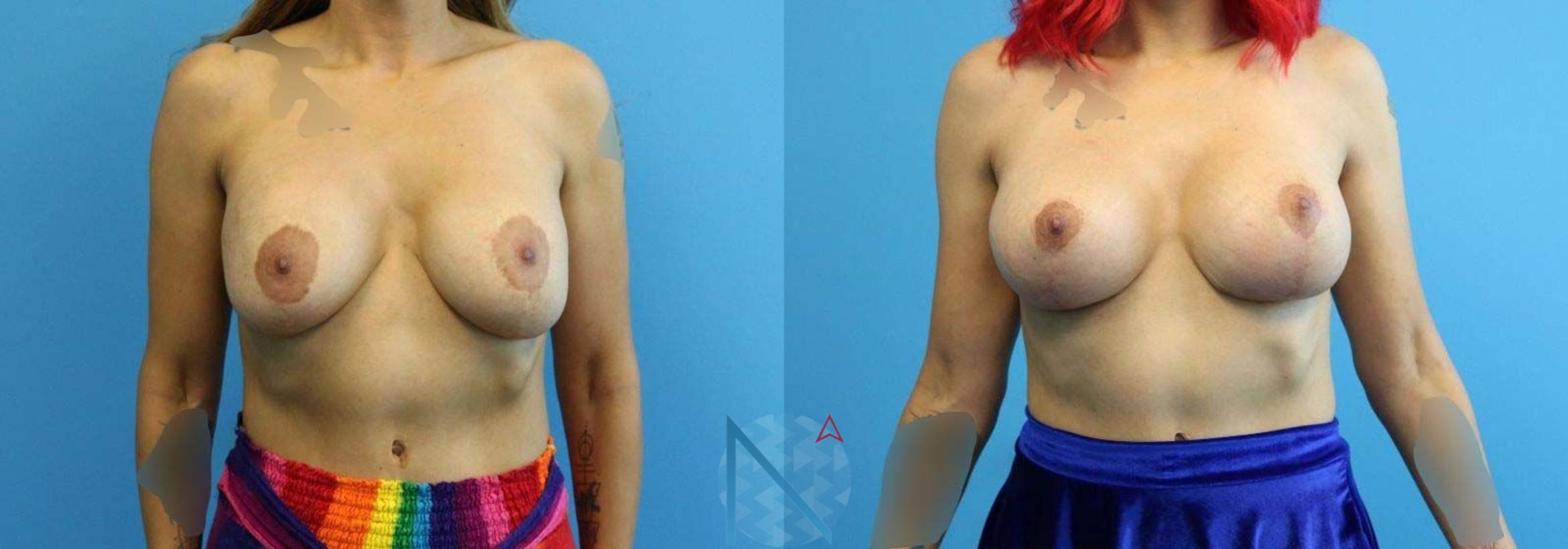 Before & After Breast Lift with Augmentation Case 63 View 1 View in Raleigh, NC