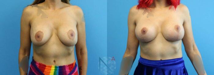 Before & After Breast Lift with Augmentation Case 63 View 1 View in Raleigh, NC