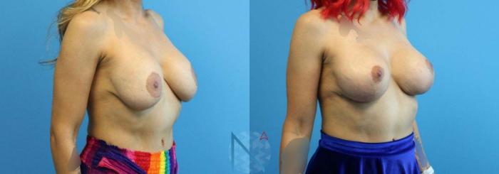 Before & After Breast Lift with Augmentation Case 63 View 2 View in Raleigh, NC