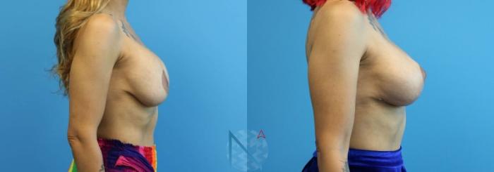 Before & After Breast Lift with Augmentation Case 63 View 3 View in Raleigh, NC