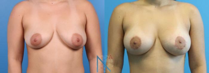 Before & After Breast Lift with Augmentation Case 64 View 1 View in Raleigh, NC