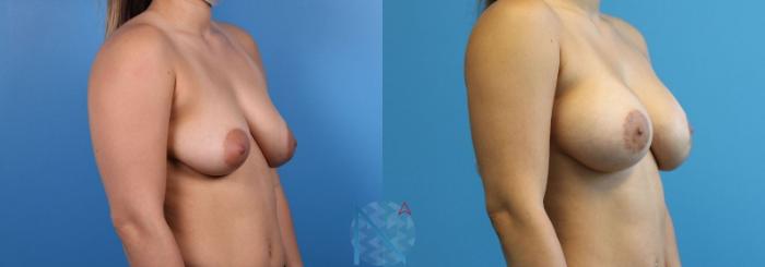 Before & After Breast Lift with Augmentation Case 64 View 2 View in Raleigh, NC