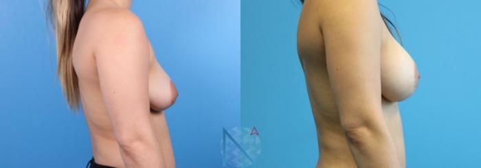 Before & After Breast Lift with Augmentation Case 64 View 3 View in Raleigh, NC