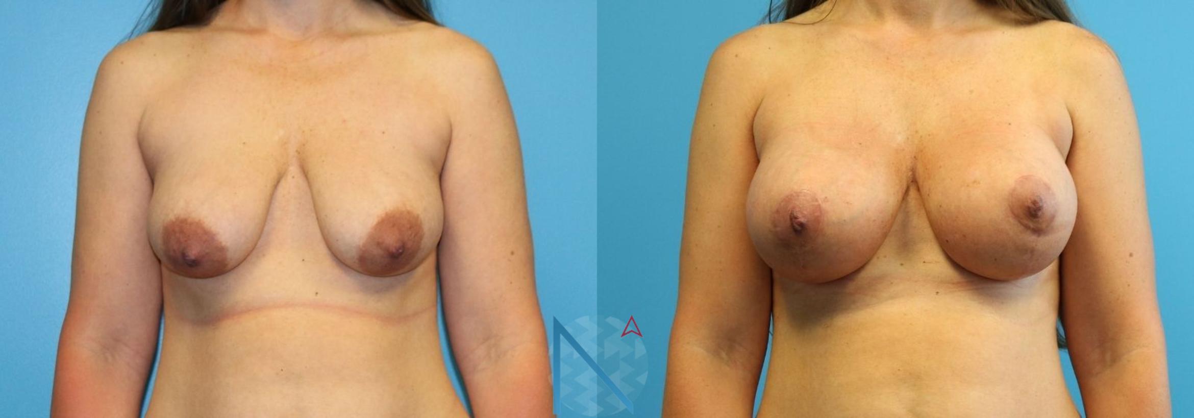 Before & After Breast Lift with Augmentation Case 65 View 1 View in Raleigh, NC