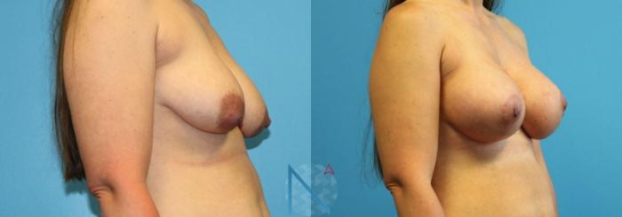 Before & After Breast Lift with Augmentation Case 65 View 2 View in Raleigh, NC