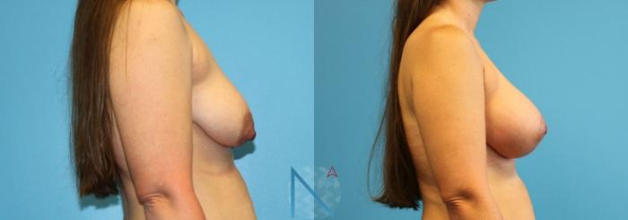 Before & After Breast Lift with Augmentation Case 65 View 3 View in Raleigh, NC