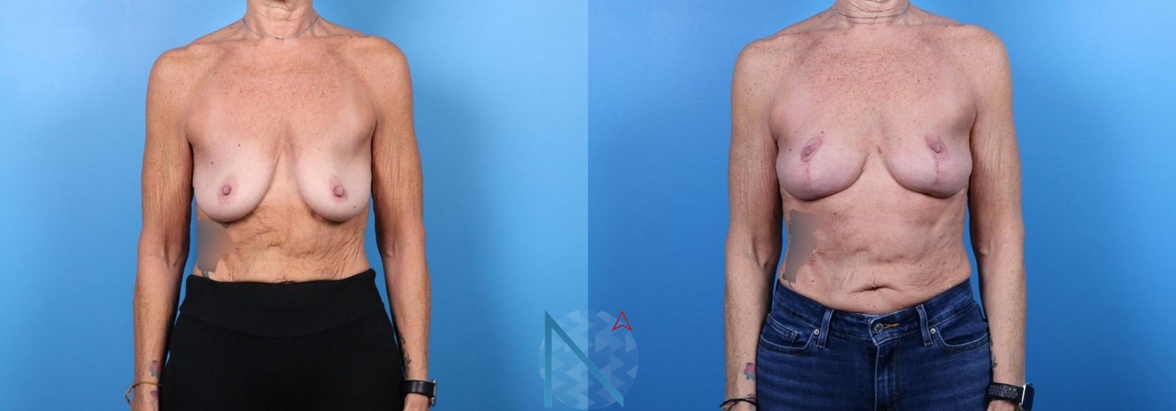 Before & After Breast Lift with Augmentation Case 66 View 1 View in Raleigh, NC