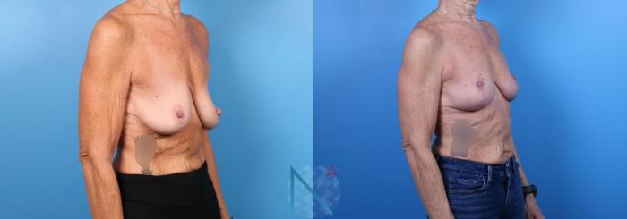 Before & After Breast Lift with Augmentation Case 66 View 2 View in Raleigh, NC