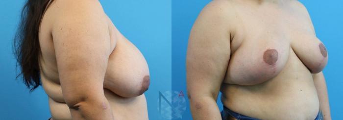 Before & After Breast Reduction Case 1 View 2 View in Raleigh, NC