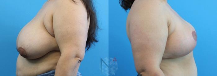 Before & After Breast Reduction Case 1 View 3 View in Raleigh, NC