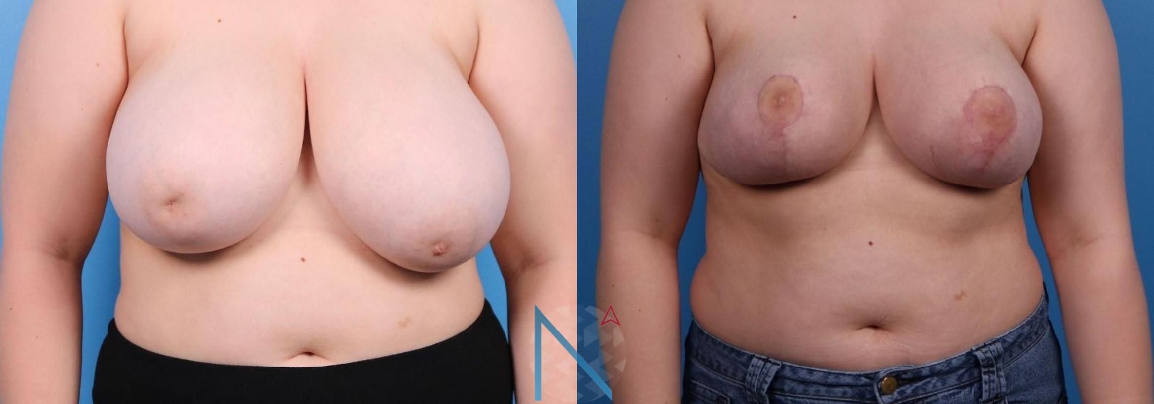 Before & After Breast Reduction Case 10 View 1 View in Raleigh, NC