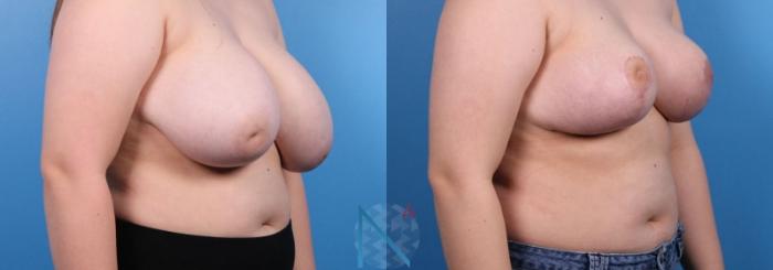 Before & After Breast Reduction Case 10 View 2 View in Raleigh, NC