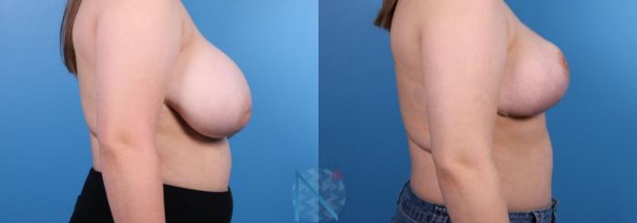 Before & After Breast Reduction Case 10 View 3 View in Raleigh, NC